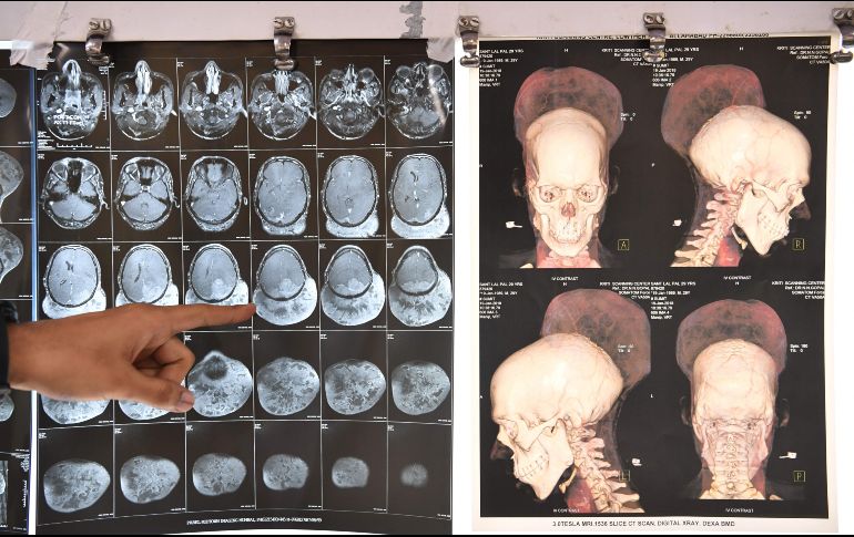 Un médico apunta hoy a la tomografía de la cabeza de un paciente en el hospital BYL Nair de Bombay. AFP/I. Mukherjee