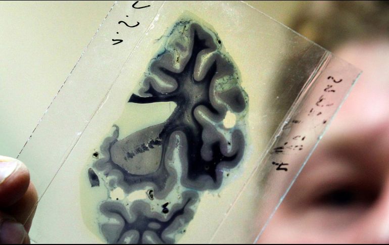 Resaltan la importancia del diagnóstico, y el medicamento que, para cada caso es distinto, personal y no debe interrumpirse, a fin de evitar que aumenten las crisis epilépticas. EFE / ARCHIVO