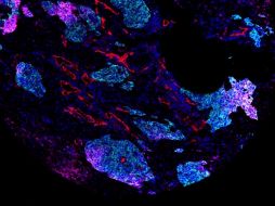 La gran diversidad de tipos de tumores es un desafío para comprender y abordar el cáncer de pulmón. ARCHIVO/EFE