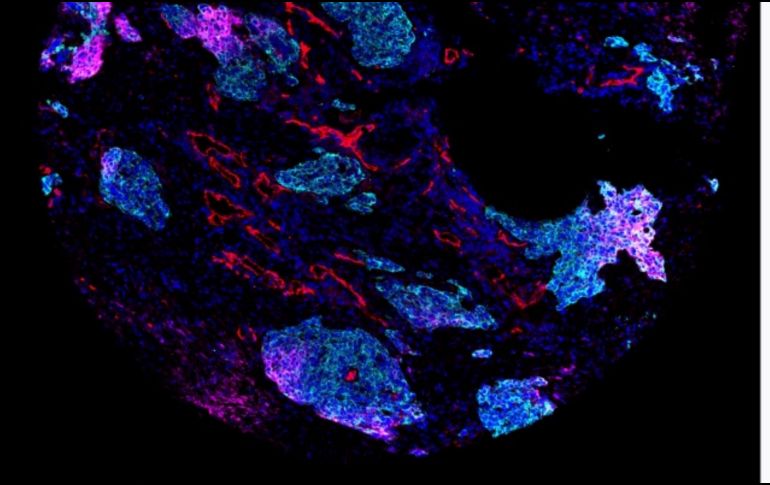 La gran diversidad de tipos de tumores es un desafío para comprender y abordar el cáncer de pulmón. ARCHIVO/EFE