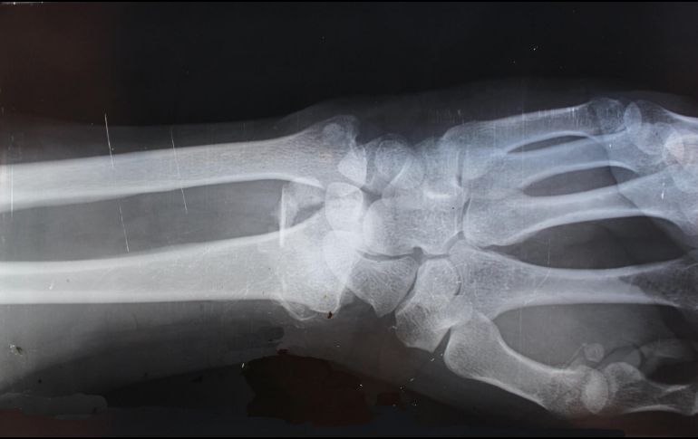 La osteoporosis es una enfermedad en la que la disminución de la masa ósea. C. SHELTON EN UNSPLASH