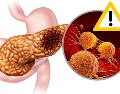 Dado que los primeros síntomas del cáncer de páncreas pueden confundirse con otras enfermedades menos graves, es fundamental acudir a un especialista ante la presencia de estas señales. CANVA