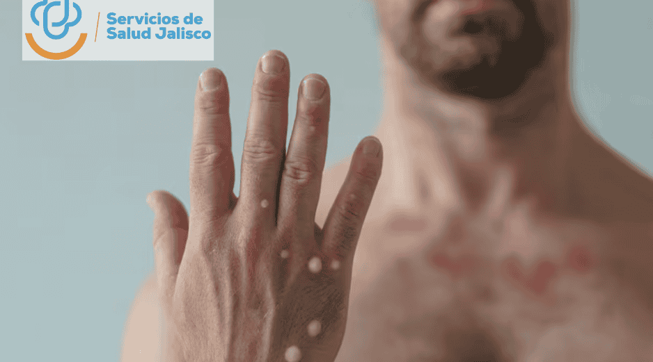 La mayoría de los casos se concentran en la metrópoli, en Puerto Vallarta y Ciudad Guzmán, dijo el titular de la SSJ. CANVA / SUN / ARCHIVO