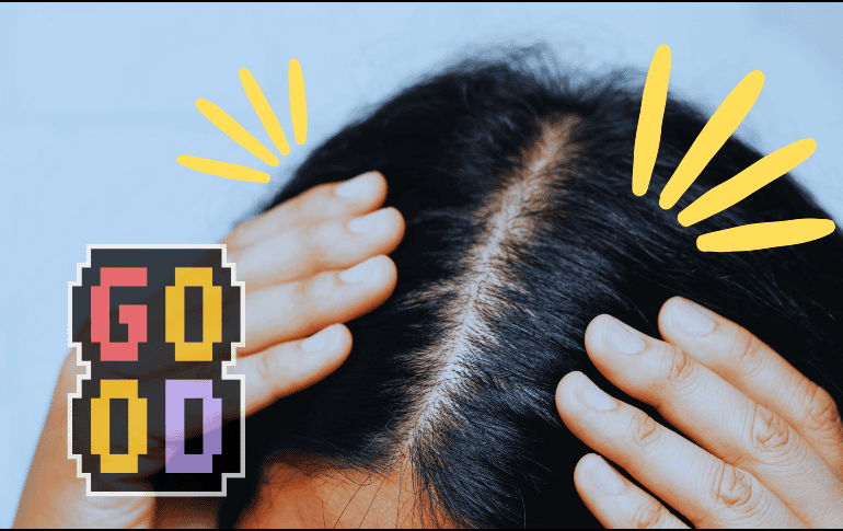 Los primeros resultados de este tratamiento para la calvicie fueron muy positivos. ESPECIAL / Canva