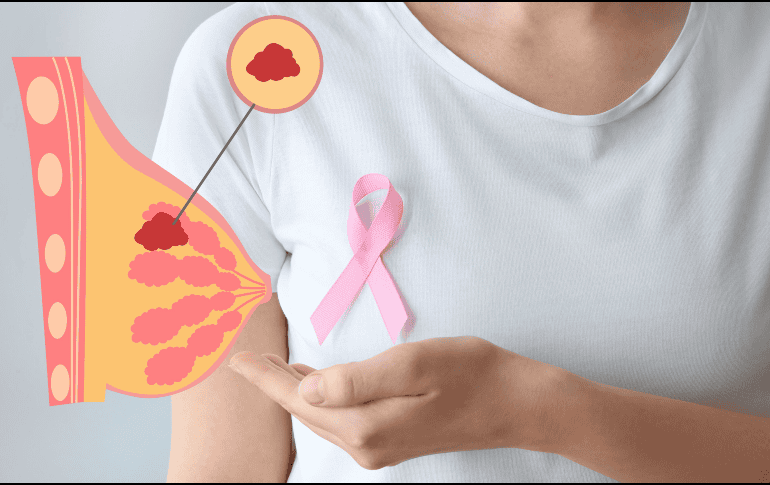 Es posible que el cáncer de mama no cause síntomas en un inicio o que el bulto sea tan pequeño que no pueda ser palpable. ESPECIAL / CANVA