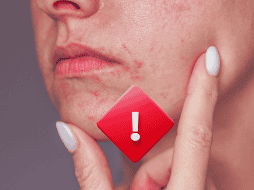 ¿Por qué sale la dermatitis perioral? No hay una causa clara, de hecho, es un conjunto de factores hormonales, predisposición genética e incluso factores ambientales. ESPECIAL / CANVA