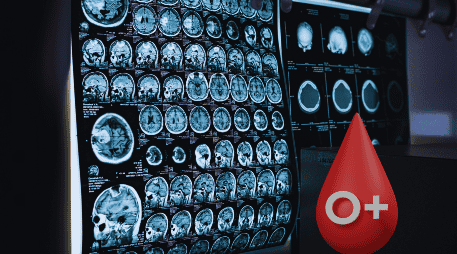 Las pruebas actuales de alzhéimer, como el análisis del líquido cefalorraquídeo o las técnicas de imagen cerebral (como el PET), son invasivas, caras o poco accesibles. ESPECIAL