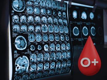 Las pruebas actuales de alzhéimer, como el análisis del líquido cefalorraquídeo o las técnicas de imagen cerebral (como el PET), son invasivas, caras o poco accesibles. ESPECIAL