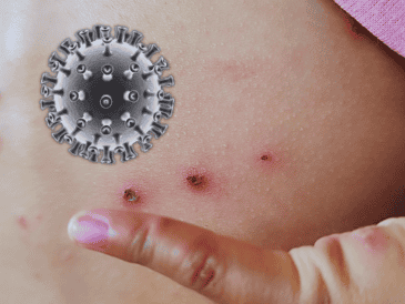 Hasta ahora, en Jalisco, sólo una bebé de dos meses proveniente de Guerrero ha fallecido en el estado a causa de esta enfermedad. ESPECIAL / CANVA