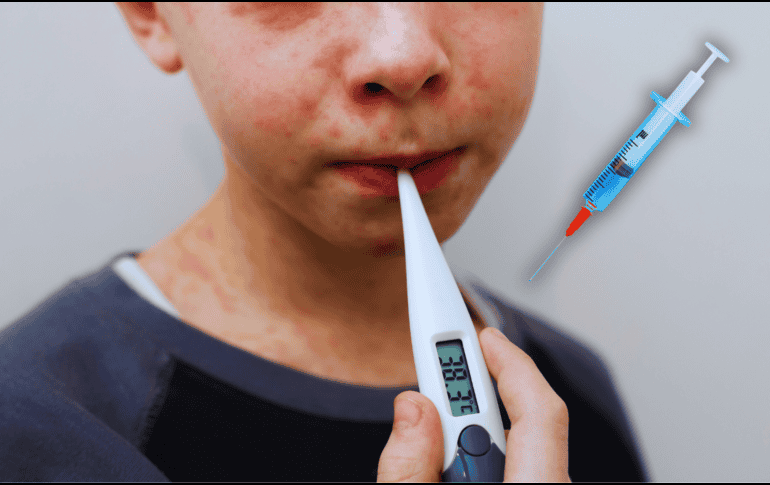 El brote más relevante de sarampión en México se concentra actualmente en Jalisco y Chiapas, aunque también se registran casos en Michoacán y Guerrero. ESPECIAL / CANVA