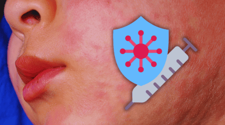 Ahora, Jalisco es el estado con mayor número de enfermos de sarampión en 2026, con 385 casos. ESPECIAL / CANVA