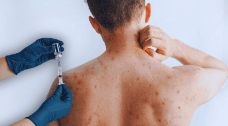 Se estima que una persona con el virus puede propagarlo durante 14 días y contagiar de sarampión hasta 18 personas; piden vacunarse. ESPECIAL / CANVA