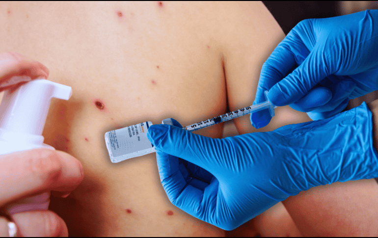 Jalisco ocupa el primer lugar nacional en lo que va del presente año en casos confirmados acumulados de sarampión, con 718. ESPECIAL / CANVA