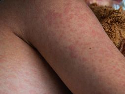 La Secretaría de Salud del estado de Tlaxcala informó el fallecimiento de un bebé de un año y un mes de edad a causa de complicaciones asociadas al sarampión. ESPECIAL / CANVA