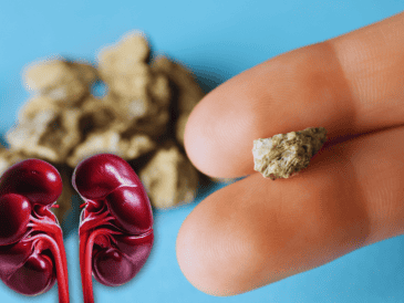 Desde luego, expulsar esas "piedras" o cálculos es bastante doloroso. Aunque si estos son detectados a tiempo, no producen daños permanentes. ESPECIAL / CANVA