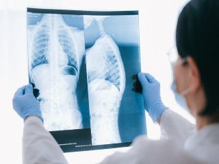 Se trata de Amivantab y Lazertinib, combinación de medicamentos ya disponible en México, que podría ser utilizado por la gran mayoría de pacientes con este tipo de cáncer como sustituto a la quimioterapia. Pexels