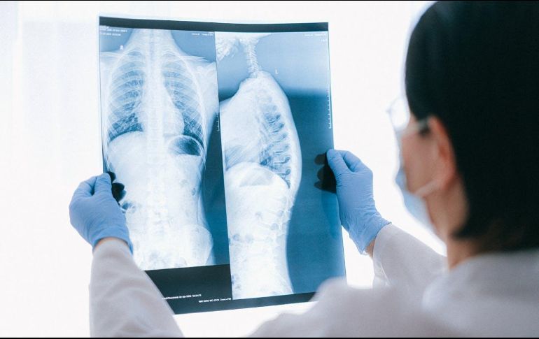 Se trata de Amivantab y Lazertinib, combinación de medicamentos ya disponible en México, que podría ser utilizado por la gran mayoría de pacientes con este tipo de cáncer como sustituto a la quimioterapia. Pexels