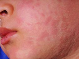 La Secretaría de Salud dio a conocer que en Hidalgo se registran siete casos confirmados de sarampión en los municipios de Pachuca, Actopan y Santiago de Anaya. Se trata de tres menores de edad y cuatro adultos. ESPECIAL / CANVA