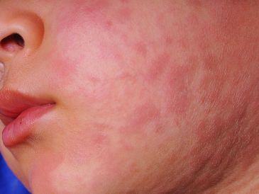 La Secretaría de Salud dio a conocer que en Hidalgo se registran siete casos confirmados de sarampión en los municipios de Pachuca, Actopan y Santiago de Anaya. Se trata de tres menores de edad y cuatro adultos. ESPECIAL / CANVA