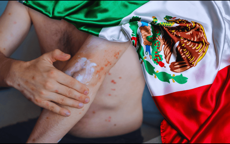 De acuerdo con cifras oficiales, entre 2025 y 2026 se han registrado 9 mil 74 casos acumulados de sarampión en México. ESPECIAL / CANVA