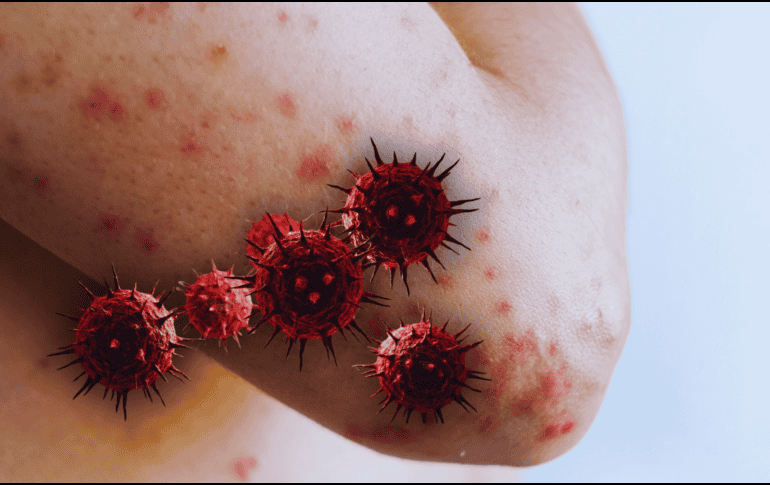 El riesgo del sarampión no se limita a la erupción cutánea, sino a las secuelas permanentes que puede dejar en el organismo. ESPECIAL / CANVA