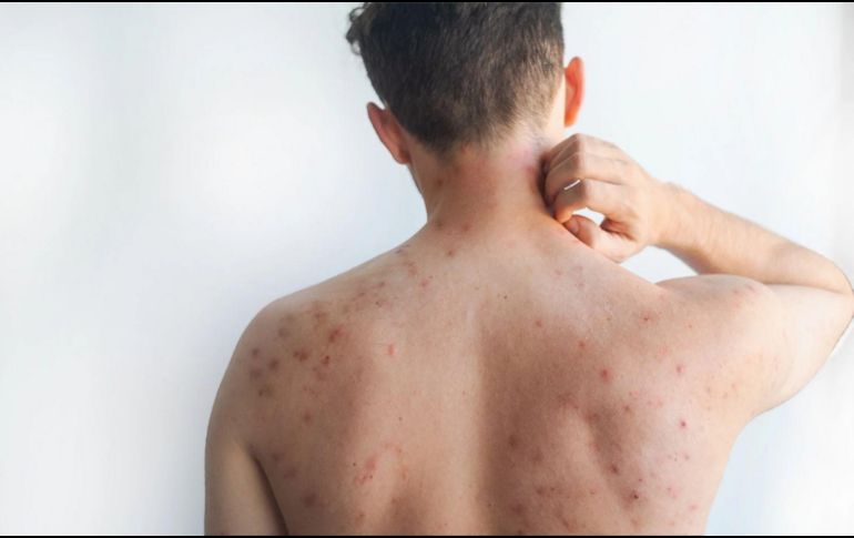 De acuerdo con la Organización Mundial de la Salud (OMS), hay algunas acciones que puedes realizar para mejorar algunos síntomas. ESPECIAL/Canva