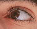 La miopía se desarrolla cuando la iluminación deficiente de la retina no genera una actividad retiniana sólida. ESPECIAL