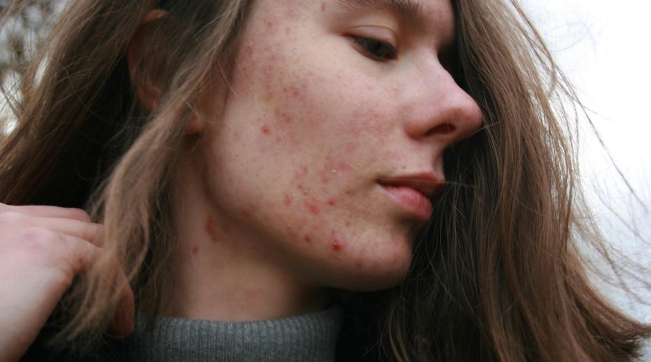 Los multivitamínicos son suplementos alimenticios y algunos pueden causar acné. UNSPLASH /  B. KRYSZTOFIAK