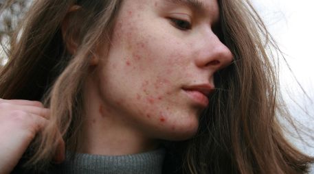 Los multivitamínicos son suplementos alimenticios y algunos pueden causar acné. UNSPLASH /  B. KRYSZTOFIAK