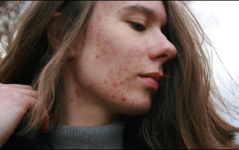 Los multivitamínicos son suplementos alimenticios y algunos pueden causar acné. UNSPLASH /  B. KRYSZTOFIAK