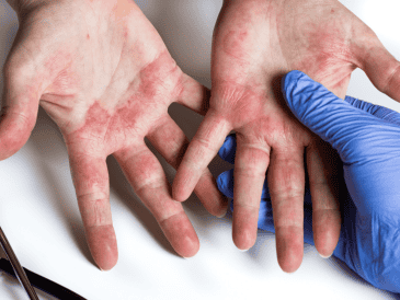 En distintos sectores de la población también son comunes afecciones como la dermatitis del pañal, las fotodermatosis, los trastornos fotoplurícos y las micosis, entre otras enfermedades cutáneas. CANVA