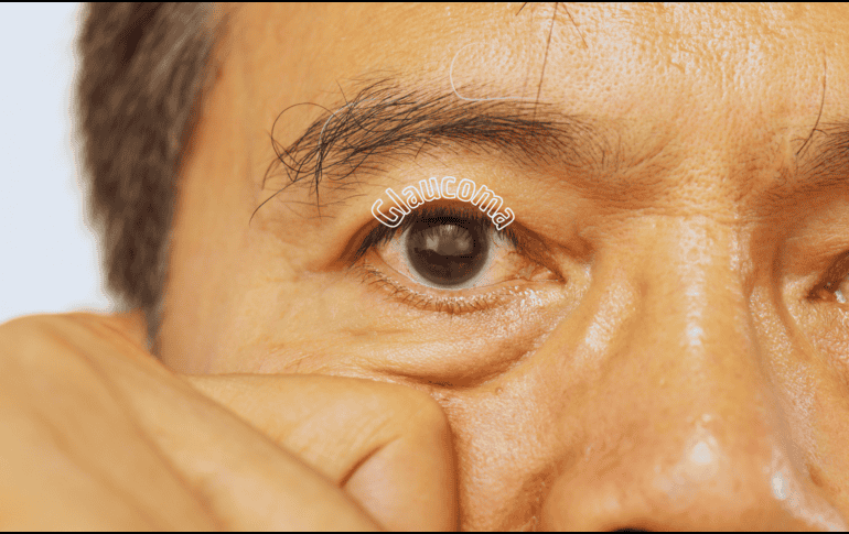 El glaucoma puede presentarse a cualquier edad, pero suele ser más común en adultos mayores. ESPECIAL / CANVA
