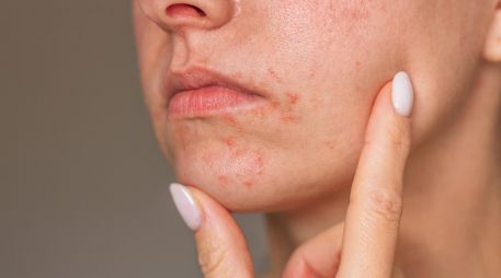 El estrés psicológico activa respuestas inmunitarias que agravan la dermatitis en la piel. ESPECIAL / CANVA