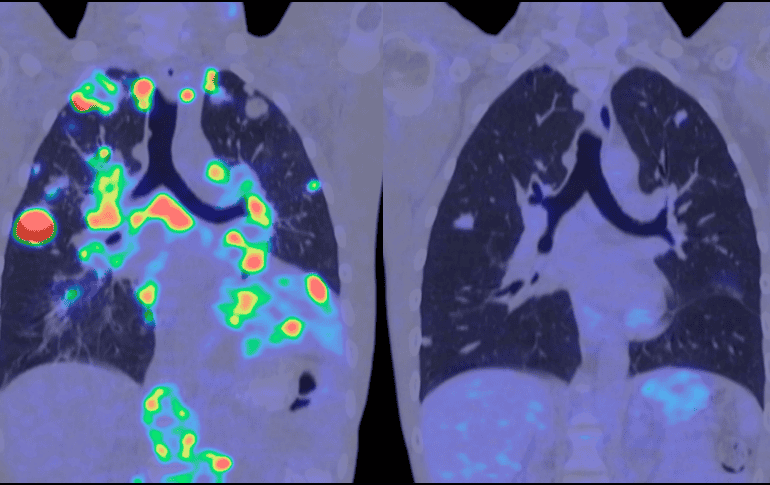 El análisis de sangre para detectar el cáncer, también denominado biopsia líquida, no es nuevo. ESPECIAL