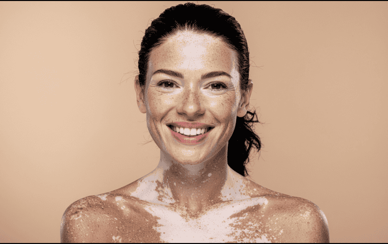 Actualmente no existe una cura definitiva para el vitiligo, pero sí tratamientos que pueden ayudar a controlar la despigmentación o mejorar la apariencia de la piel.  CANVA