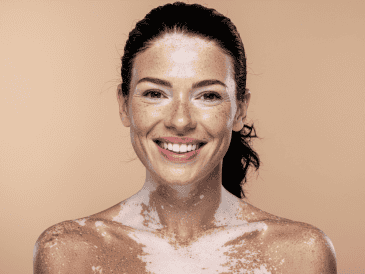 Actualmente no existe una cura definitiva para el vitiligo, pero sí tratamientos que pueden ayudar a controlar la despigmentación o mejorar la apariencia de la piel.  CANVA