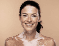Actualmente no existe una cura definitiva para el vitiligo, pero sí tratamientos que pueden ayudar a controlar la despigmentación o mejorar la apariencia de la piel.  CANVA