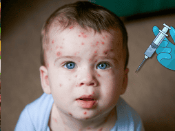 La vacuna contra la varicela ayuda a proteger contra el virus varicela-zóster, responsable de provocar esta enfermedad altamente contagiosa que suele manifestarse con ronchas, fiebre y malestar general. CANVA