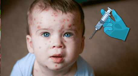 La vacuna contra la varicela ayuda a proteger contra el virus varicela-zóster, responsable de provocar esta enfermedad altamente contagiosa que suele manifestarse con ronchas, fiebre y malestar general. CANVA
