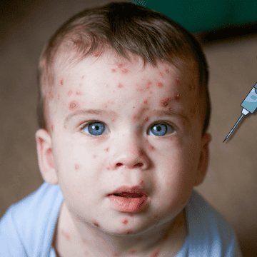 La vacuna contra la varicela ayuda a proteger contra el virus varicela-zóster, responsable de provocar esta enfermedad altamente contagiosa que suele manifestarse con ronchas, fiebre y malestar general. CANVA