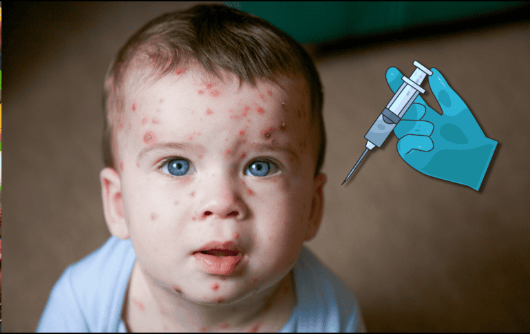La vacuna contra la varicela ayuda a proteger contra el virus varicela-zóster, responsable de provocar esta enfermedad altamente contagiosa que suele manifestarse con ronchas, fiebre y malestar general. CANVA