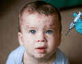 La vacuna contra la varicela ayuda a proteger contra el virus varicela-zóster, responsable de provocar esta enfermedad altamente contagiosa que suele manifestarse con ronchas, fiebre y malestar general. CANVA