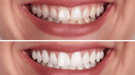 El sarro aparece formalmente cuando la placa bacteriana (una capa pegajosa compuesta por microorganismos vivos y restos de alimentos cotidianos) no se elimina correctamente mediante el uso diario del cepillo y el hilo dental en el hogar. CANVA