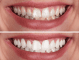 El sarro aparece formalmente cuando la placa bacteriana (una capa pegajosa compuesta por microorganismos vivos y restos de alimentos cotidianos) no se elimina correctamente mediante el uso diario del cepillo y el hilo dental en el hogar. CANVA