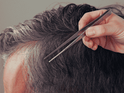 La extracción mecánica y repetida puede inflamar de manera severa esta delicada estructura anatómica, alterando su funcionamiento normal. ESPECIAL / CANVA