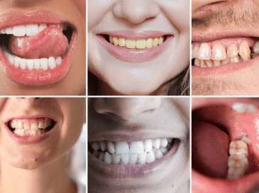 Mantener una buena higiene oral, acudir a revisiones periódicas y prestar atención a cualquier cambio visible sigue siendo la mejor estrategia para prevenir complicaciones y conservar una sonrisa saludable. CANVA