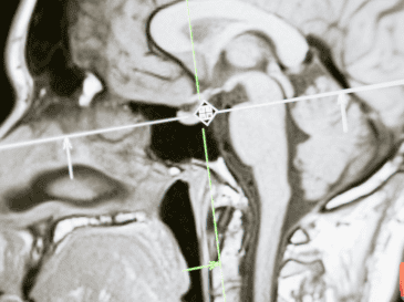 Esta técnica permite controlar la actividad de células nerviosas específicas mediante haces de luz, una capacidad que ha transformado la investigación del cerebro y abierto nuevas posibilidades para estudiar enfermedades neurológicas y psiquiátricas. CANVA
